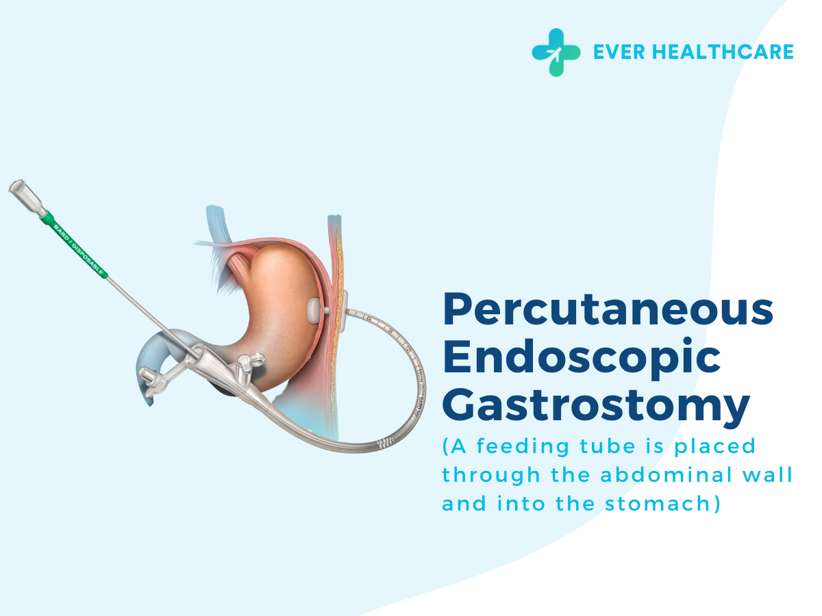 Percutaneous Endoscopic Gastrostomy in Thailand 2023 Compare Price
